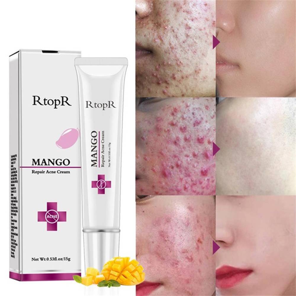 Oem Mango Repair Acne Cream Anti Spots Acne Treatment Scar Blackhead Cream Shrink Pores Whitening Moisturizing Face Skin Care